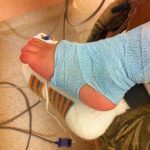 IV in foot IV in foot